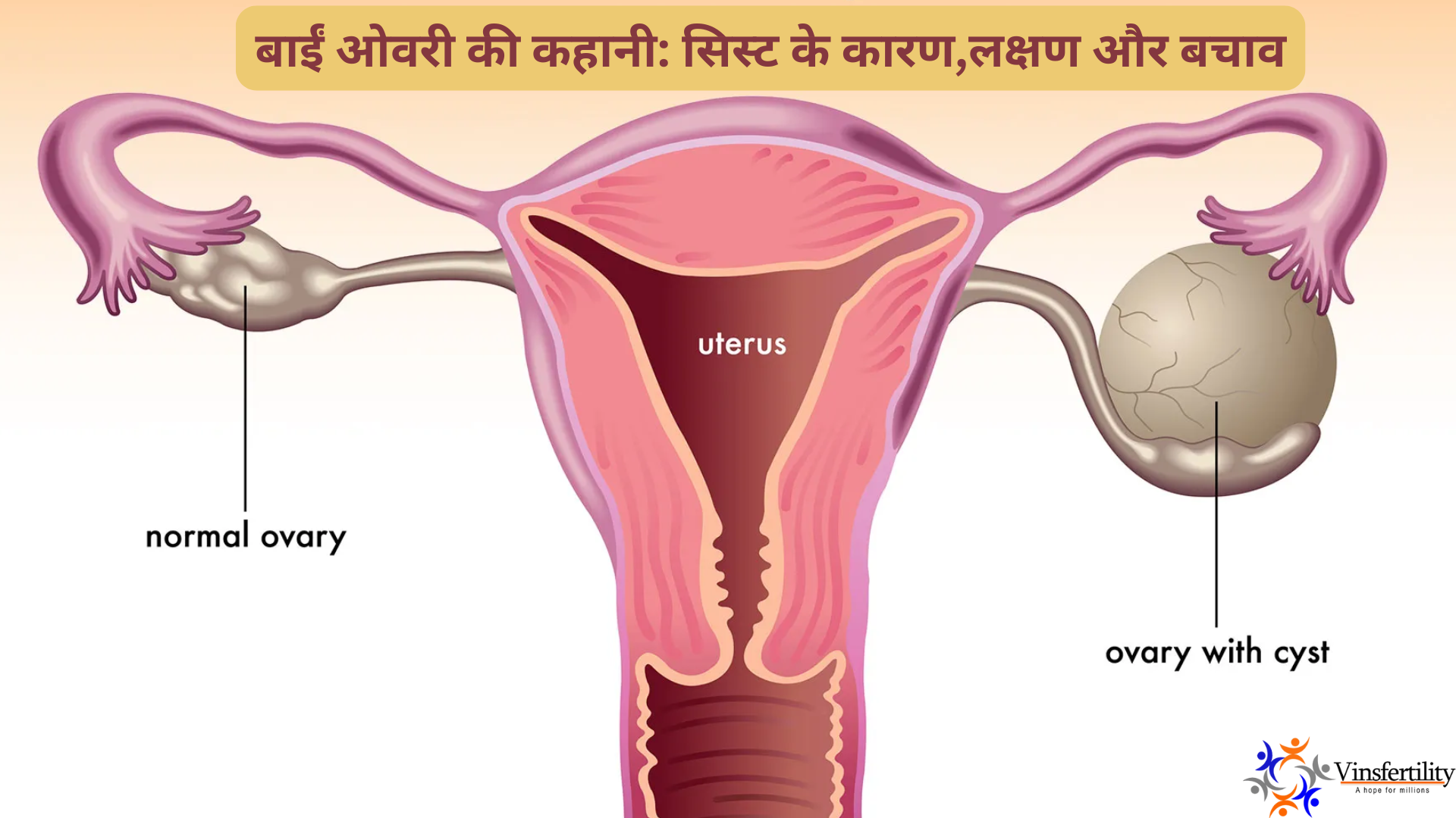 Left Ovarian Cyst In Hindi| ओवरी में गांठ के  लक्षण | इलाज और कारण